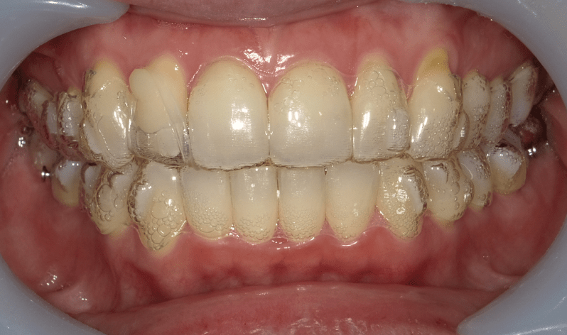 マウスピース矯正 インビザライン を補うテクニック 世田谷通りリキ歯科 矯正歯科 世田谷区の歯医者 上町駅 桜新町駅すぐ 日曜診療 18時まで