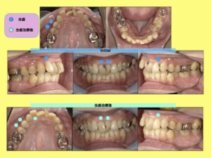 インビザライン 矯正前の虫歯治療