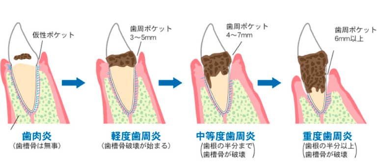 歯周検査 - 世田谷通りリキ歯科・矯正歯科|世田谷区の歯医者|上町駅・桜新町駅すぐ | 日曜診療(18時まで)