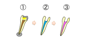 根っこの治療 流れ