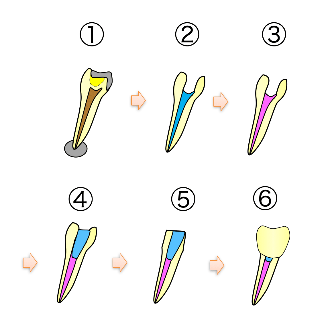 根っこの治療　流れ