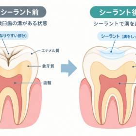 6歳臼歯のシーラント前後比較
