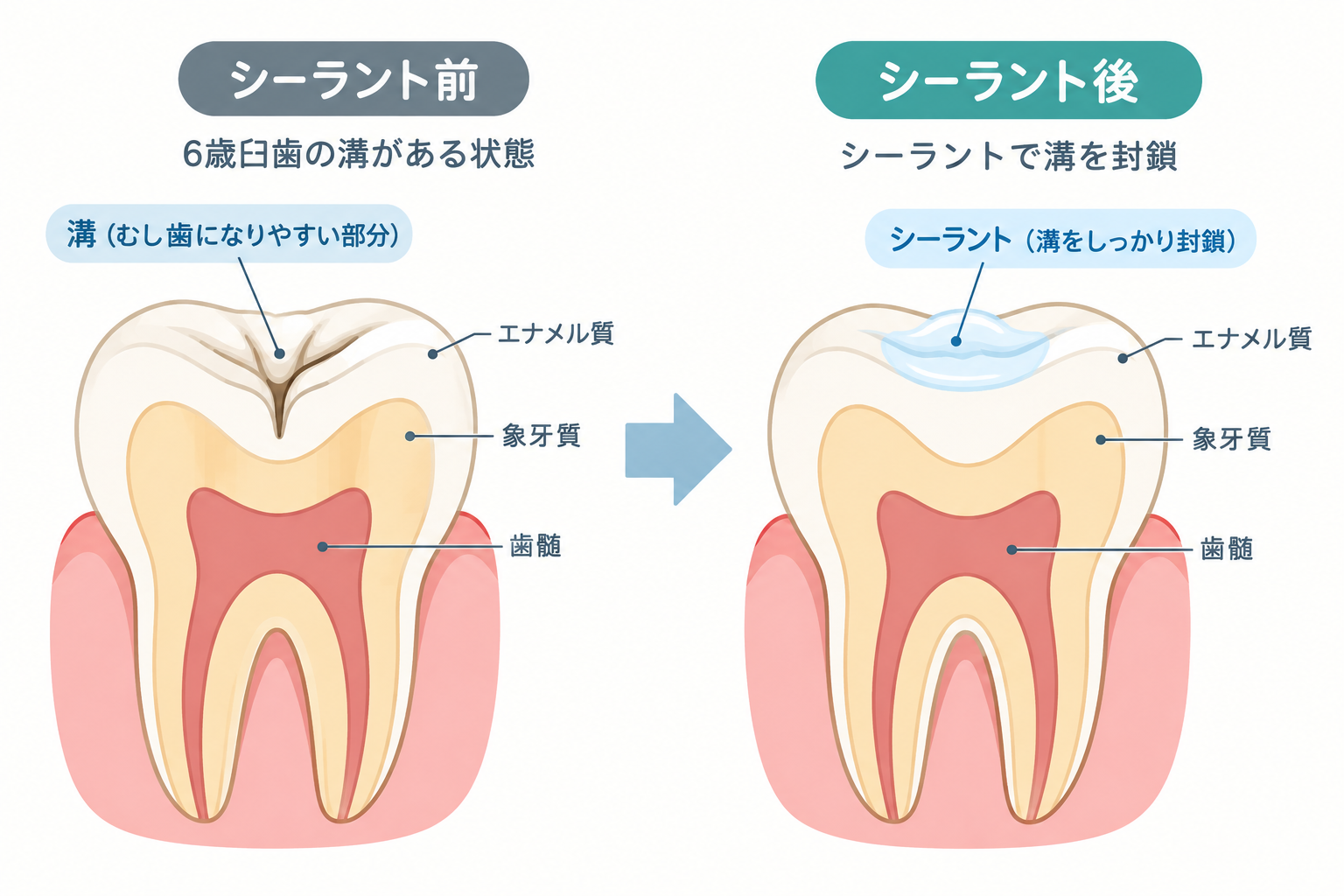 6歳臼歯のシーラント前後比較